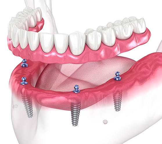 Illustration of dentures being placed on All-on-4 implants in Austin, TX