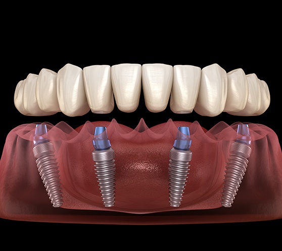 Illustration of All-on-4 implants and replacement teeth
