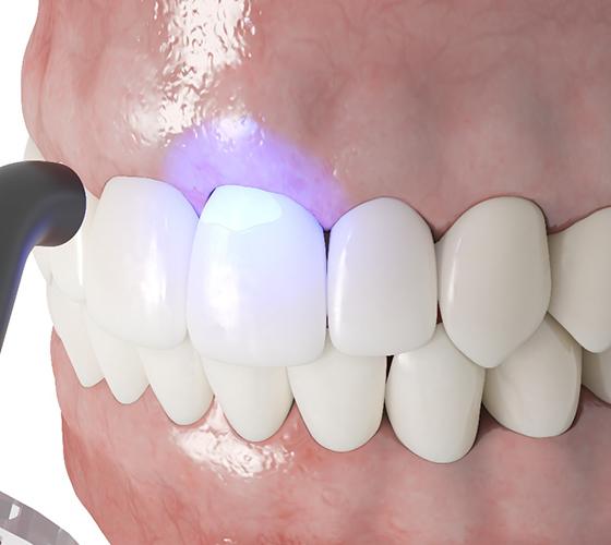 3D render of dental bonding