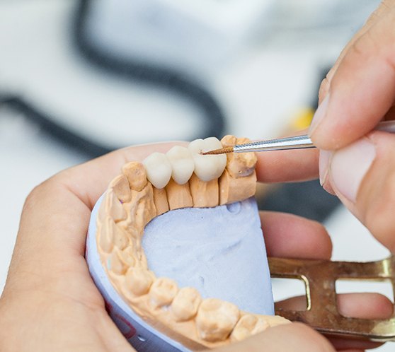 Dental bridge on set of model teeth