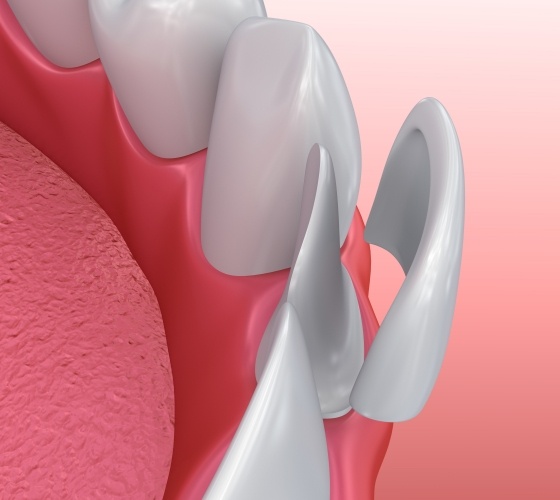 Animated smile during porcelain veneer cosmetic dentistry treatment