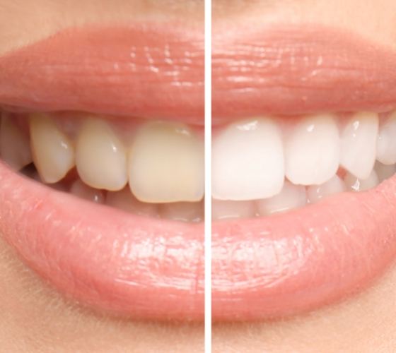 Smile before and after teeth whitening