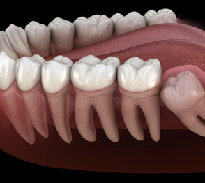 picture of an impacted tooth