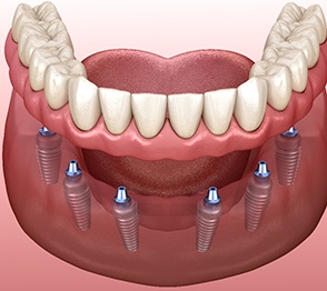 A 3D illustration of all-on-4 dentures