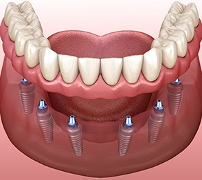 Digital illustration of implant dentures