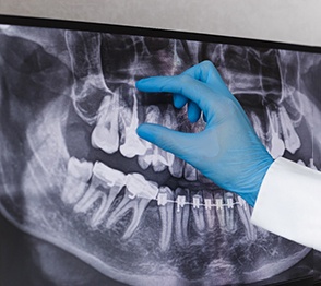 A dental X-ray in Austin, TX