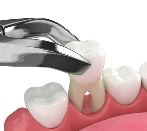 Illustration of tooth being removed