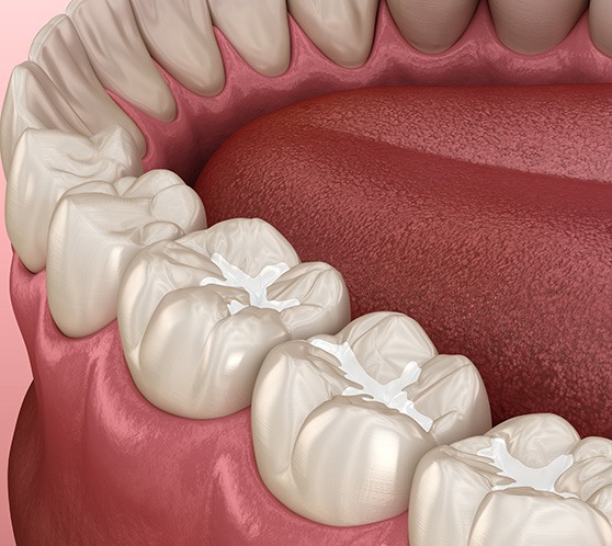 Tooth-colored fillings