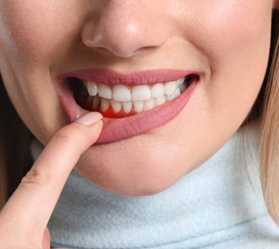 Nose-to-chin view of a blond woman pulling down her lower lip with one finger to reveal red gums