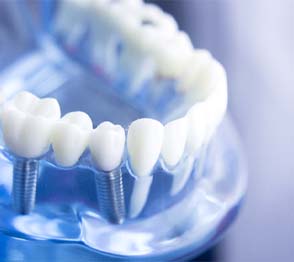 Dental implants in Austin inside a dental model