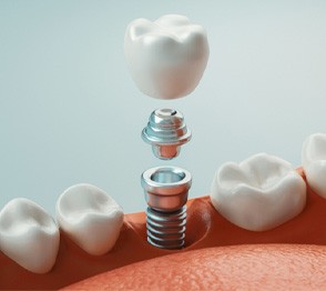 Close-up of a single dental implant in Austin, TX