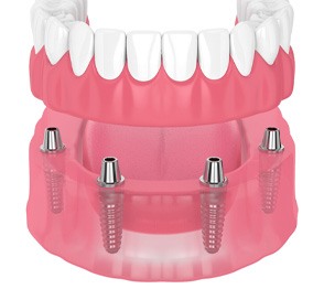Illustration of dentures and dental implants in Austin, TX