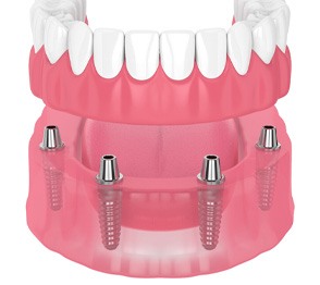 Illustration of dentures and dental implants in Austin, TX