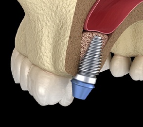 Model highlighting how dental implants in Austin are placed