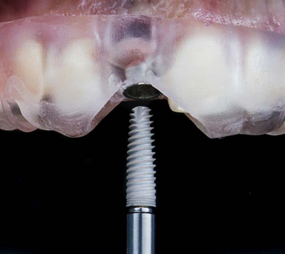 Model showing how dental implants in Austin are surgically placed