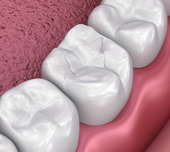 Animated smile with tooth colored filling after restorative dentistry treatment